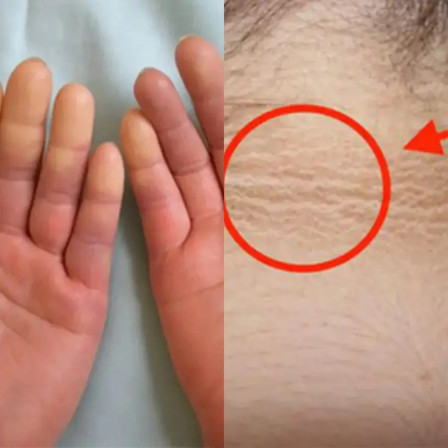 6 signs on the skin warn of diabetes, absolutely do not ignore